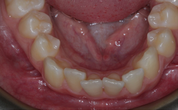 Before - Sutton Orthodontics