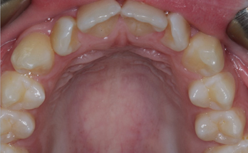 Before - Sutton Orthodontics