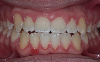 After - Sutton Orthodontics