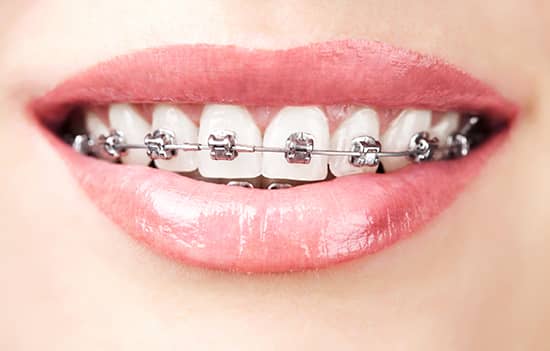 Braces - Sutton Orthodontics
